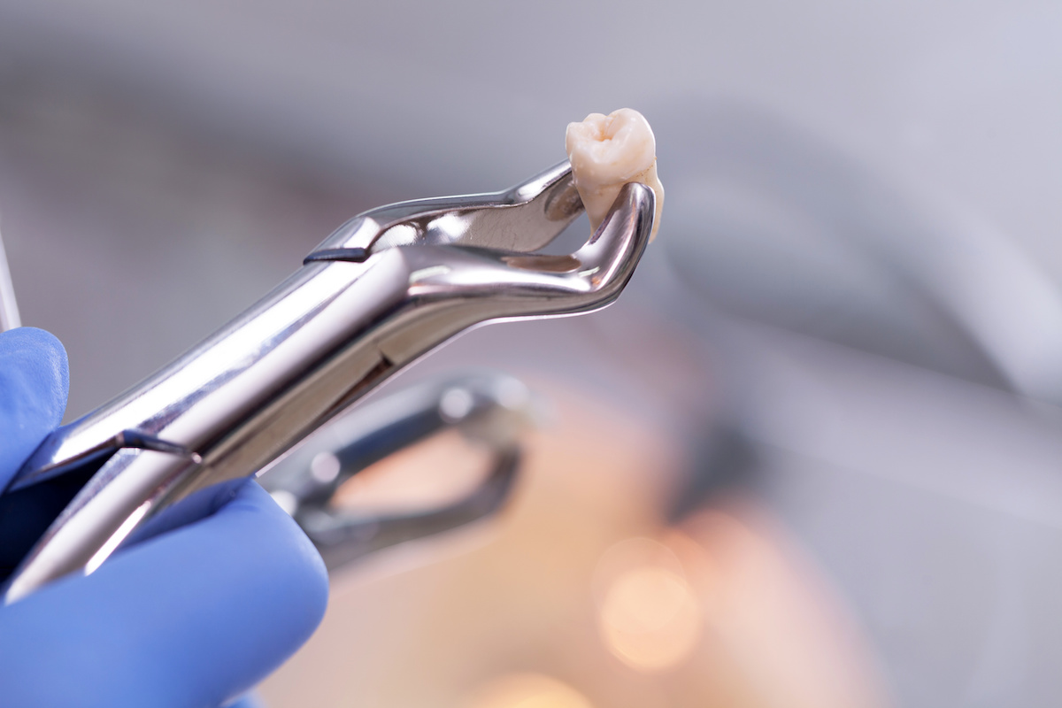 Wisdom Teeth: Everything You Need to Know