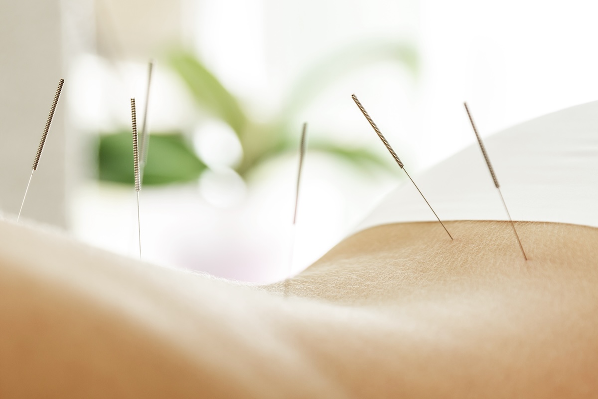 How Acupuncture Helps with Dental Treatment in Maple Ridge & Pitt Meadows